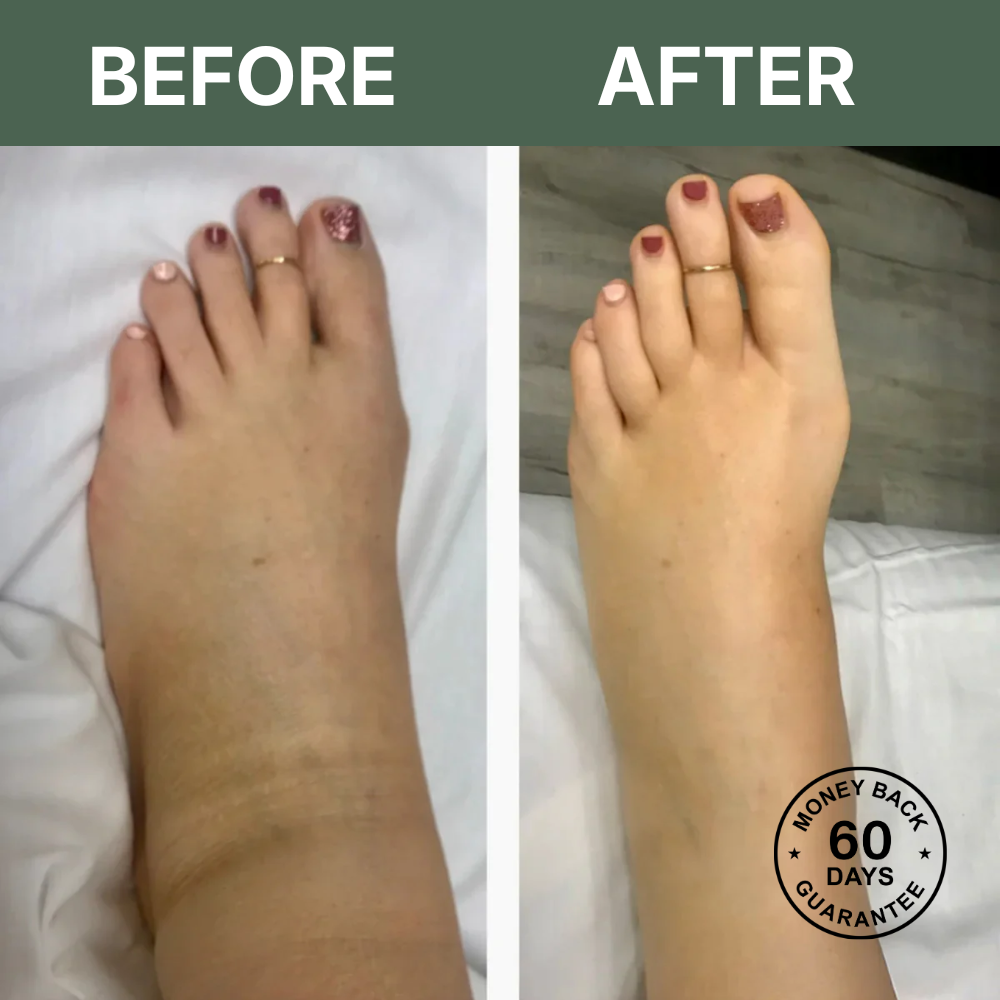 LymphaFlow™ Pro – Natural Relief for Swollen Legs In Just 15 Minutes A Day!