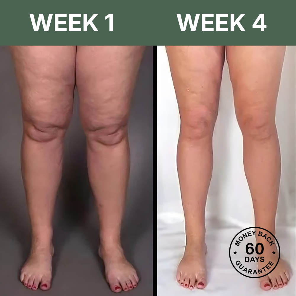 LymphaFlow™ Pro – Natural Relief for Swollen Legs In Just 15 Minutes A Day!